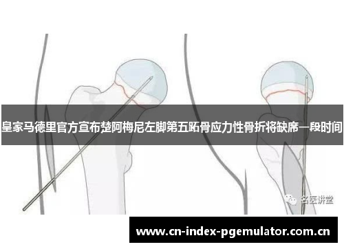 皇家马德里官方宣布楚阿梅尼左脚第五跖骨应力性骨折将缺席一段时间